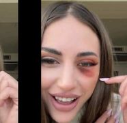 Bianca Giurcă a apărut vânătă la ochi! „Ce s-a întâmplat?”